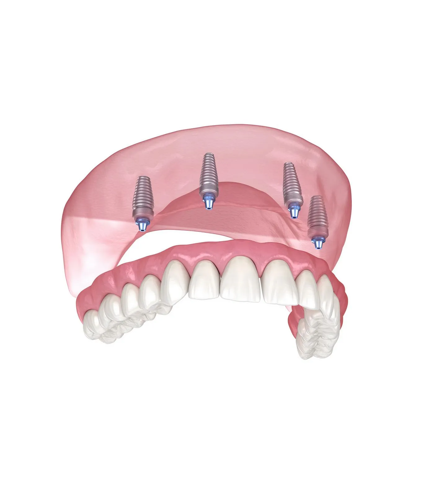 All-on-4 i All-on-6 implantati